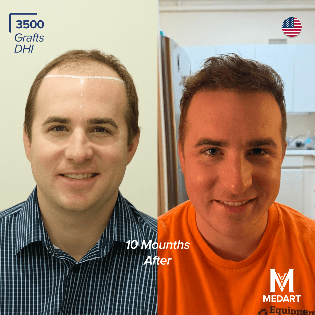 Before After transformation 3